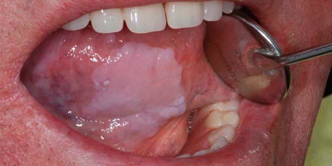 Resultado de imagen de leucoplasia oral